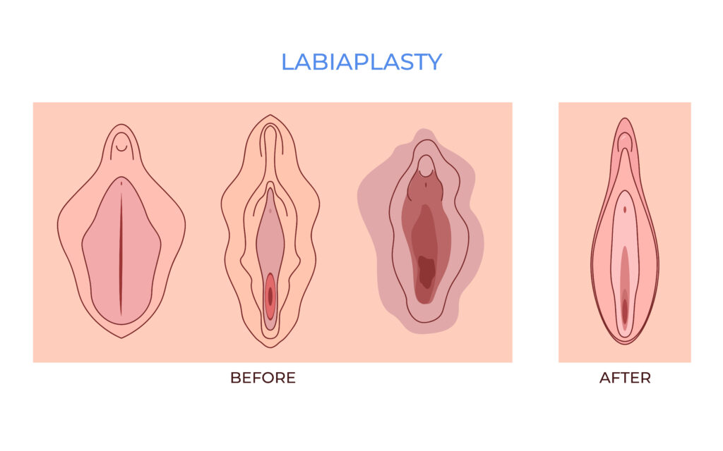 Vaginoplasty techniques and procedures