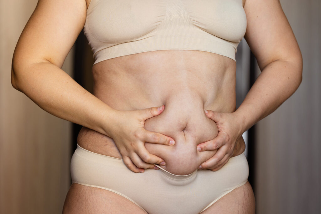 Preparing For A Tummy Tuck: What To Expect Before And After Surgery? 28 Lipedema treatment in kakinada