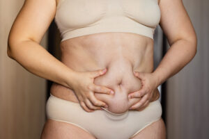Blogs 18 Lipedema treatment in kakinada