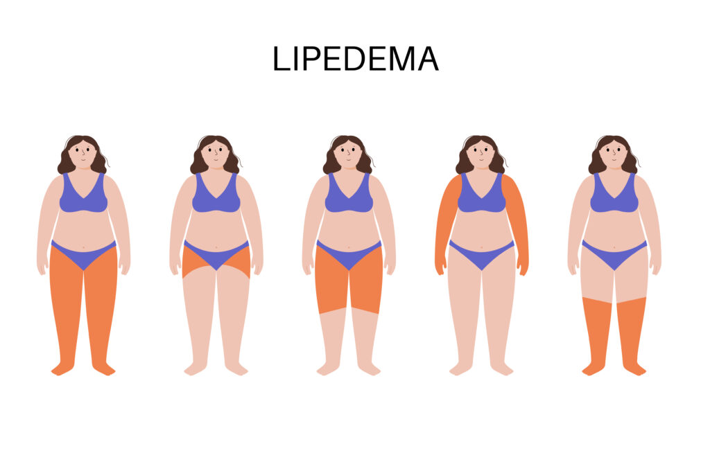 Get effective Lipedema treatment in Kakinada. Our experienced medical professionals provide personalized care to improve quality of life.