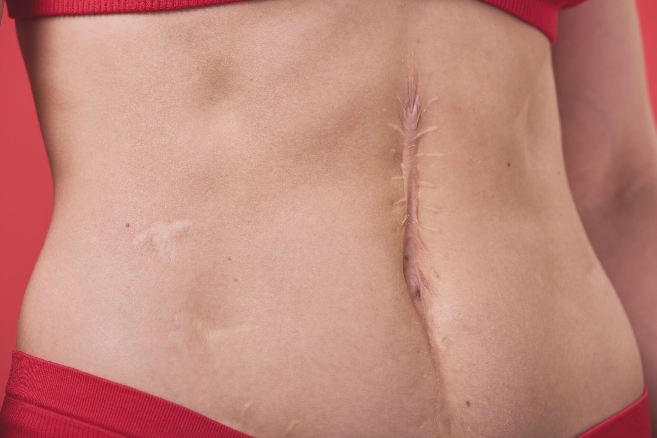 Management Of Caesarean Scars