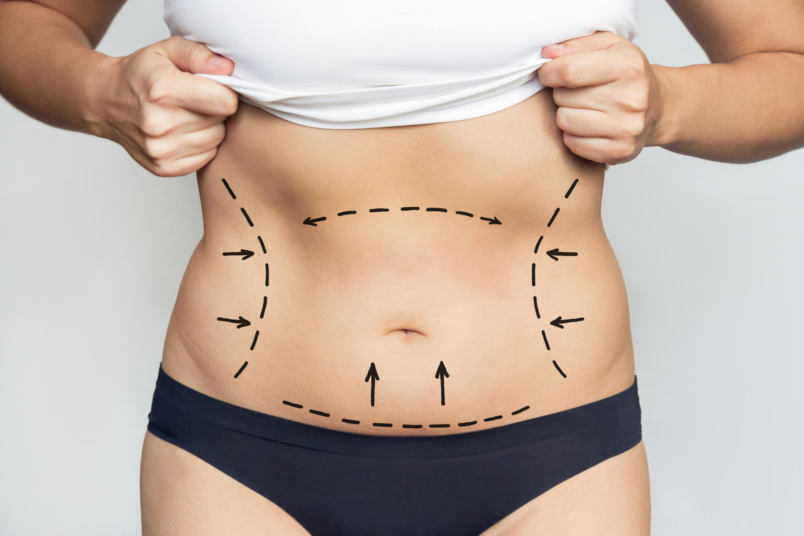 preparing for a tummy tuck
