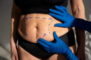Lipedema Treatment in Andhra Pradesh