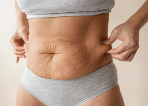 Effective Path for Lipedema Treatment in Andhra Pradesh 2 Lipedema Treatment in Andhra Pradesh