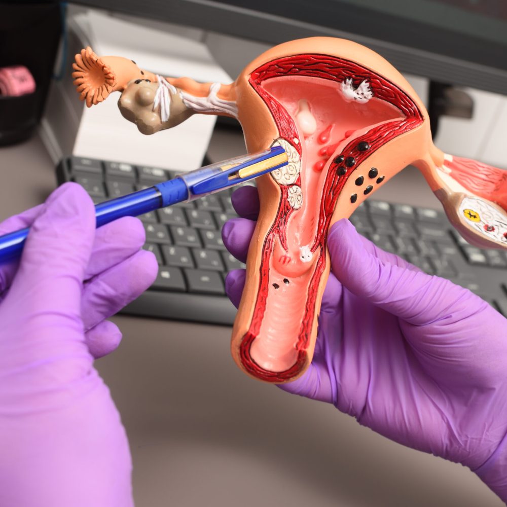 model of a human uterus in the hands of a gynecologist close-up. Women's consultation